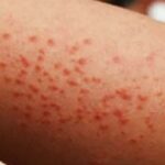 Sarampión se expande por todo México; piden vacunarse