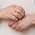 Casos de sarampión en México durante 2026 ya superan el total del año pasado